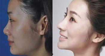 鼻骨塌陷图片,影像学特征与治疗策略